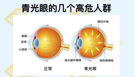 青光眼的幾個高危人群？