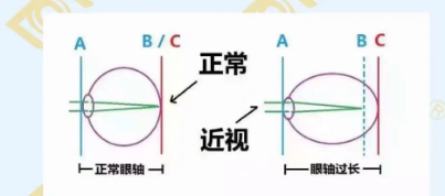 哪個(gè)年齡近視度數(shù)最容易增長(zhǎng)？