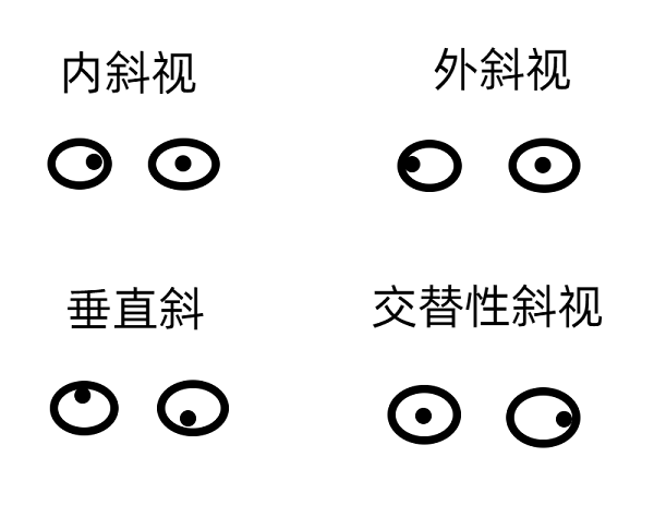 斜視早期的癥狀有哪些？